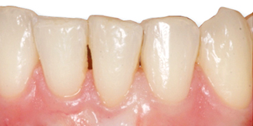 Gingival recession